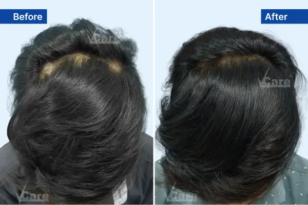 Alopecia-Areate treatment