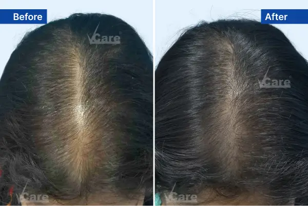 Alopecia-Areate treatment