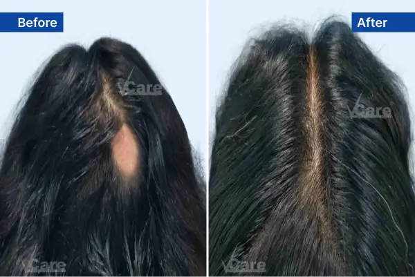 Alopecia-Areate treatment