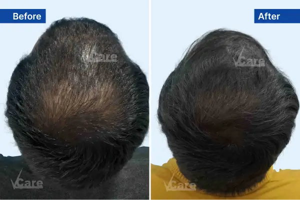 Hair Thinning treatment