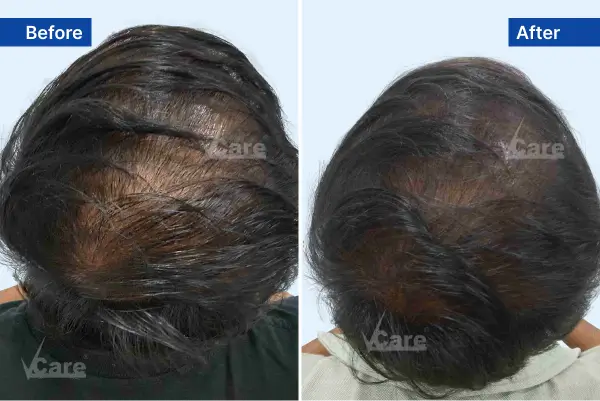 Hair Thinning treatment