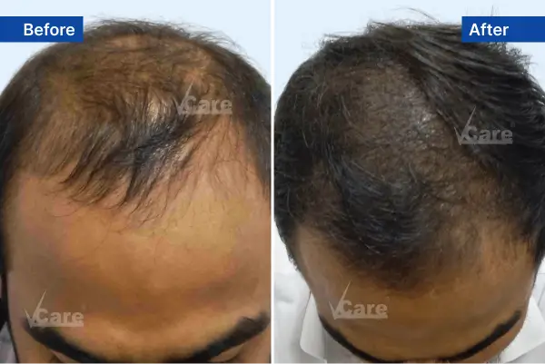 Hair Thinning treatment