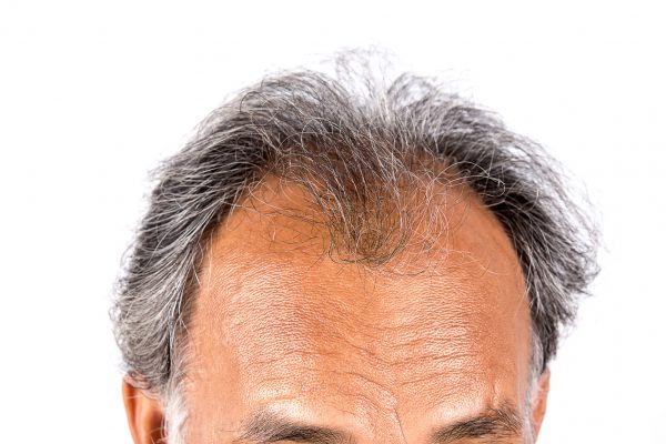 Best Treatment for Hair Loss