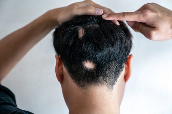 Best Treatment for Hair Loss