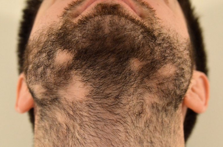 Best Treatment for Hair Loss