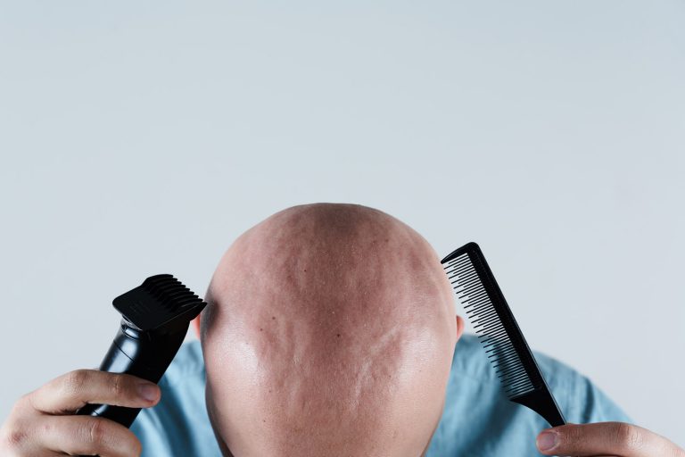 Best Treatment for Hair Loss