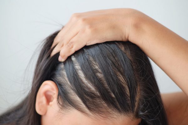 Best Treatment for Hair Loss