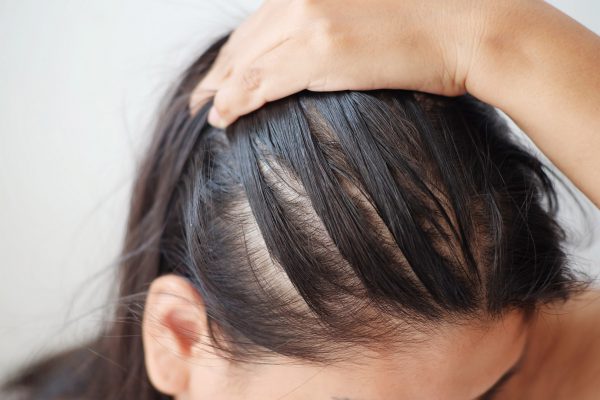 Best Treatment for Hair Loss