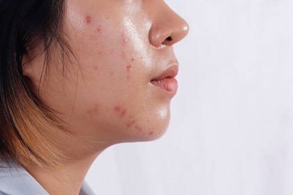 Best-Acne-Treatment-For-Oily-Skin
                        