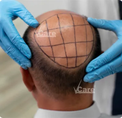 Baldness treatment