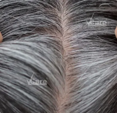 Premature-Greying treatment
