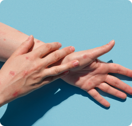 Psoriasis treatment