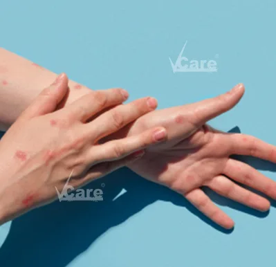 Psoriasis treatment