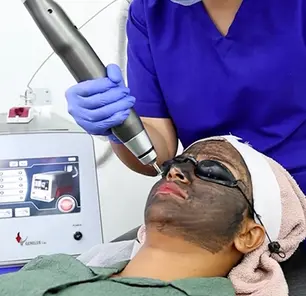 Carbon-Laser-Peel treatment